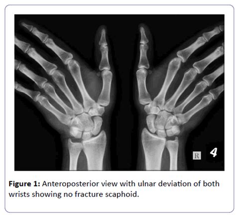 Ulnar Deviation X Ray