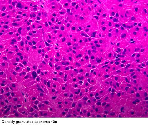 Pathology Outlines - Pituitary adenoma