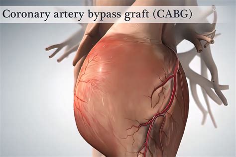 Heart Bypass Surgery Videos Procedure | ERemedium