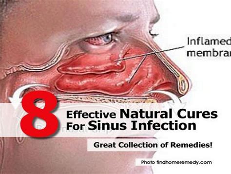 8 Effective Natural Cures For Sinus Infection