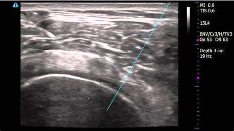 Right Shoulder Subacromial Bursitis diagnosed by Ultrasound with injection - YouTube