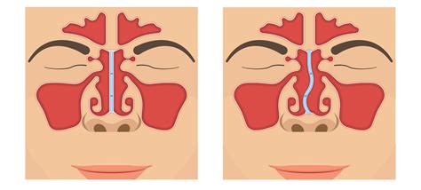 Deviated Septum - Dr. Aykut Unsal | Philadelphia