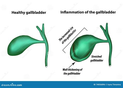 Symptoms of Gallbladder Inflammation. Cholecystitis Stock Vector ...