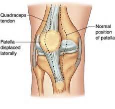 Patellar Dislocation - Sports Injuries, treatment and performance information