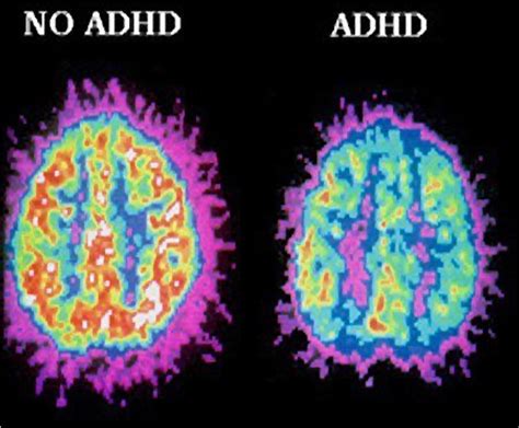 About ADHD | Adult ADHD Centre