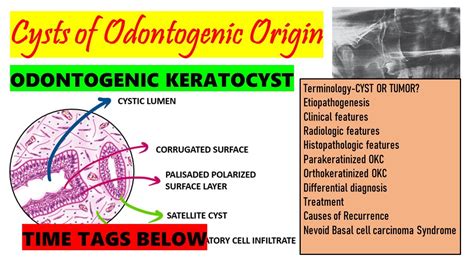 Odontogenic Keratocyst| HISTOPATHOLOGY |TREATMENT | Causes of recurrence DETAILED (part 2) Time ...