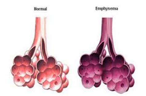 Lipoid Pneumonia