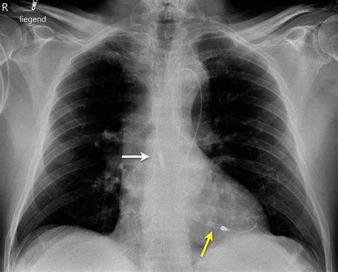 Impella Chest X Ray