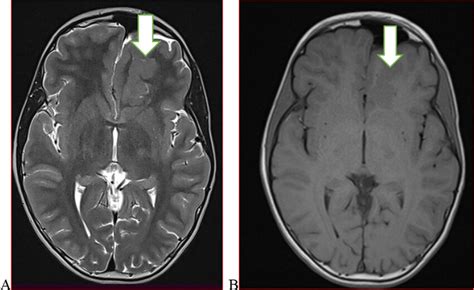 Thirteen-year-old male with focal seizures. Axial T2 (A) and T1 (B)... | Download Scientific Diagram