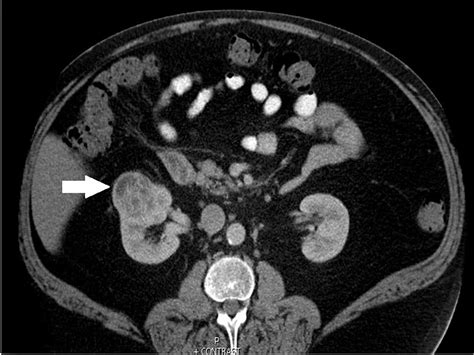 Cureus | Recurrent Chylothorax in Renal Cell Carcinoma