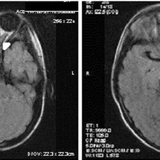 MRI showing optic glioma affecting the optic chiasm; left - thickening ...