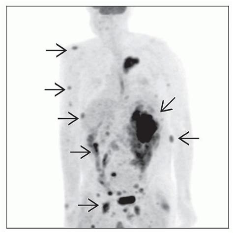 Plasmablastic Lymphoma | Basicmedical Key