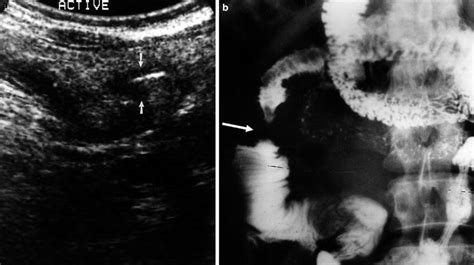 Intestinal Tuberculosis | Radiology Key