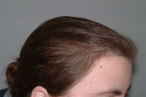 Case-7930 | Leonard Hair Transplant Associates