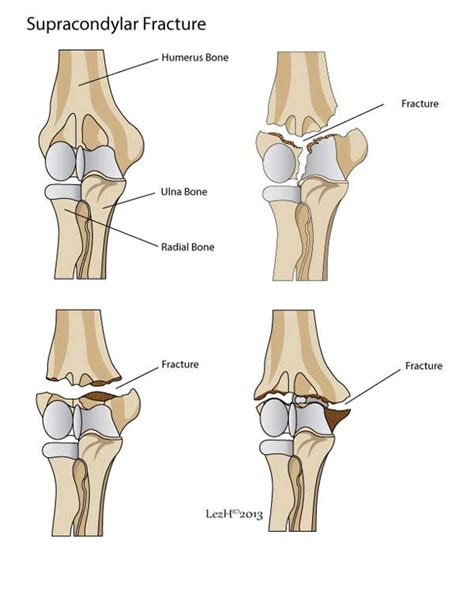 Fractured Elbow - Orthoanswer