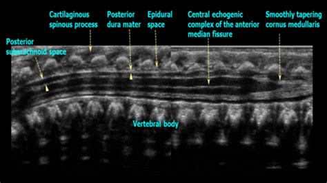 Infant Spine Ultrasound Images Flashcards | Quizlet