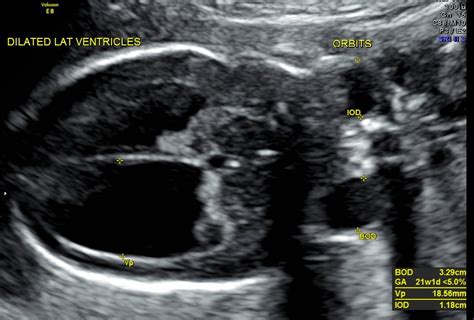 Holoprosencephaly,Right Atrial Isomerism,Coarctation of Aorta,Neural Tube Defect,Renal Dysplasia ...