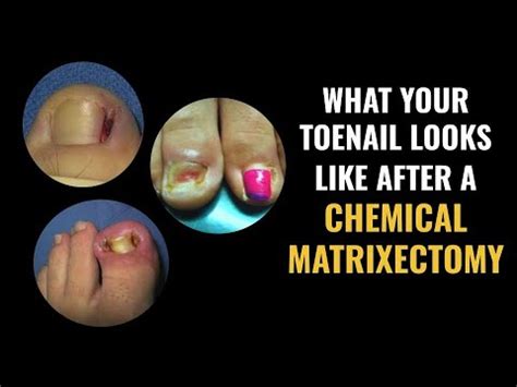 What your toenail looks like after a chemical matrixectomy - YouTube