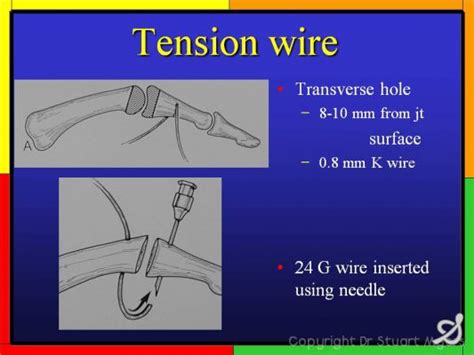 Tension Band Wiring