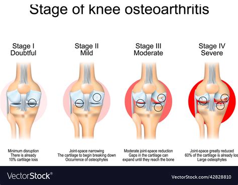 Stages of knee osteoarthritis Royalty Free Vector Image