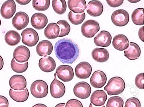 Plasmacytoid lymphocyte - 1.