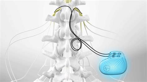 Neuromodulation or Neurostimulation Des Moines, IA | Central States Pain Clinic