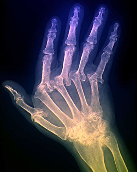 Ulnar Deviation X Ray