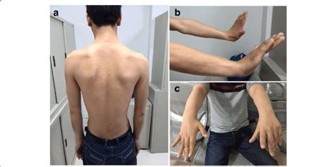 Winged Scapula Test