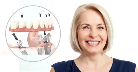 What dental implants are better? - Alpha Dent Implants