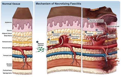 Necrotizing Fasciitis Under A Microscope