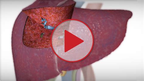 Segment IVa/VIII liver resection for Hepatocellular Carcinoma (HCC) - - Toronto Video Atlas of ...