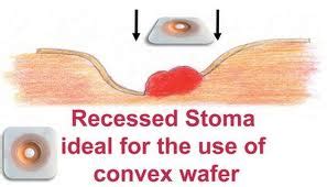 Colostomy Friends of the Philippines: Recessed Stoma