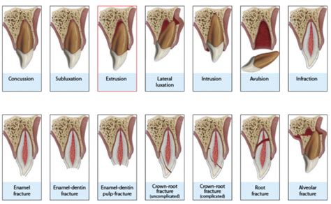 Traumatic Dental Injuries - Dr. Yehuda J. Benjamin, DMD, FAGD, MS - Aventura Endodontist