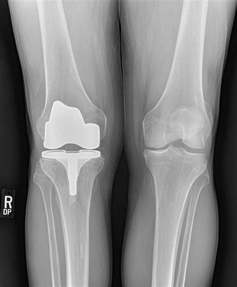 KNEE REPLACEMENT 6 | Buyxraysonline