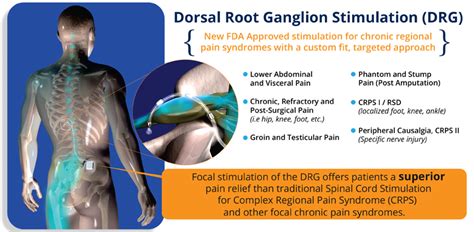 Dorsal Root Ganglion Stimulator - Dr. Mikiko Murakami