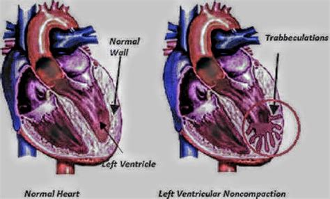 Left Ventricular Non-Compaction Cardiomyopathy - PT Master Guide