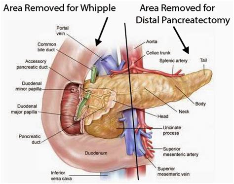 Distal Pancreatectomy – Pancreatic Surgery, when Pancreas Tail and Body are Removed - Pancreatic ...