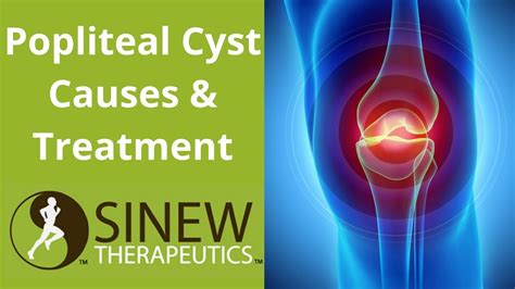 Popliteal Cyst Causes and Treatment - YouTube