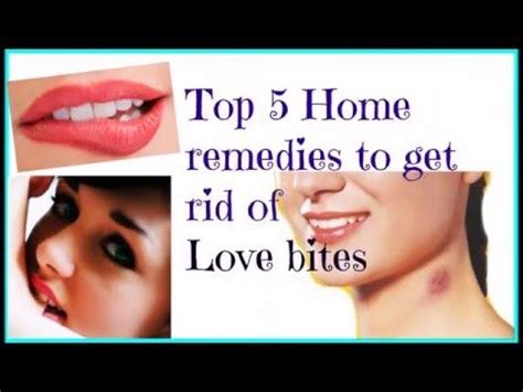 Tips-Top 5 Home remedies to get rid of Love bites | Health skin care, Skin essentials, Diy skin care