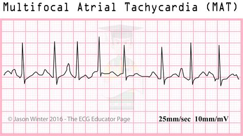 ECG Educator Blog : Atrial Rhythms