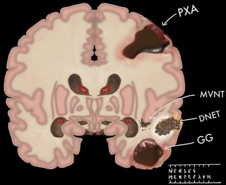 Differential diagnoses for temporal lobe tumours | Radiology Reference Article | Radiopaedia.org