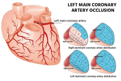 Best Treatment for Left Main Coronary Artery Disease at Medicover