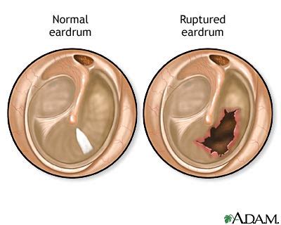 impossible songs: Eardrum damage