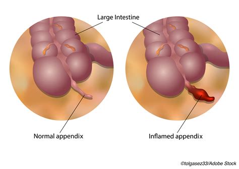 More Support for Single-Drug Antibiotics for Uncomplicated Appendicitis - Physician's Weekly