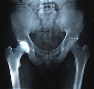 Hip Transient Osteoporosis Denver, CO | Hip Joint Pain Aurora, Highlands Ranch