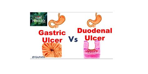 GASTRIC vs DUODENAL ULCERS - Pathology Made Simple