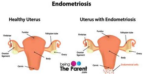 Fallopian Tube Cysts During Pregnancy- Causes, Symptoms And Treatments ...