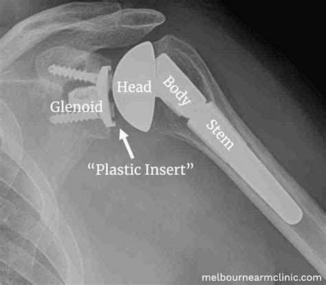 A Guide to Reverse Shoulder Replacement Surgery & Recovery