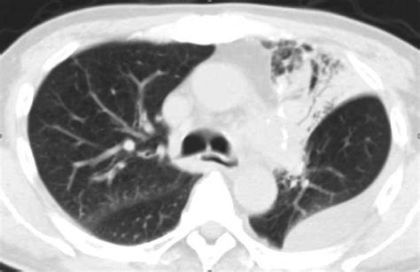 A CT scan of the patient's chest obtained on postoperative day 6,... | Download Scientific Diagram