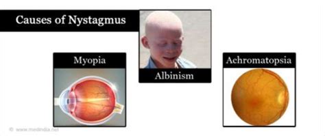 Nystagmus: Causes, Symptoms, And Treatment | Types Of Nystagmus